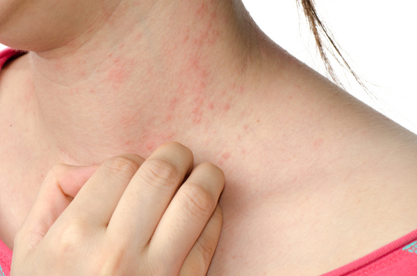 Allergi 4134 3